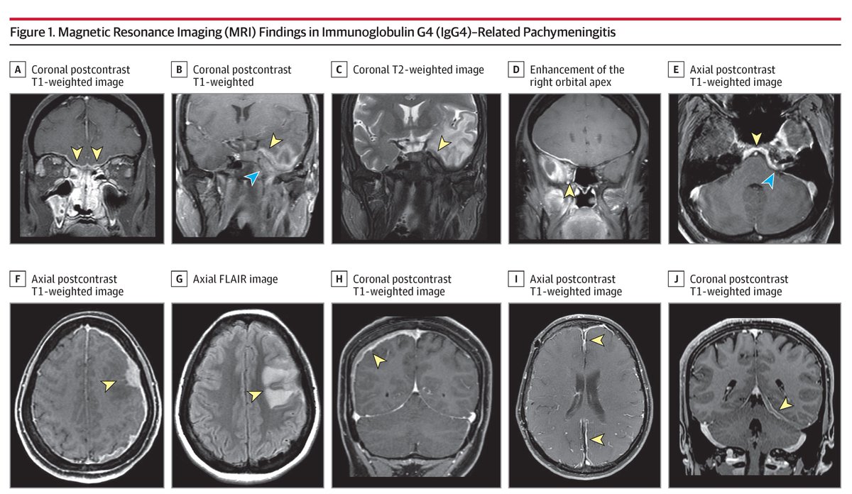 IgG4-RD pachymeningitis often causes headache and cranial nerve problems, is best diagnosed with MRI and biopsy, and frequently relapses despite treatment. ja.ma/3Qv5lPK