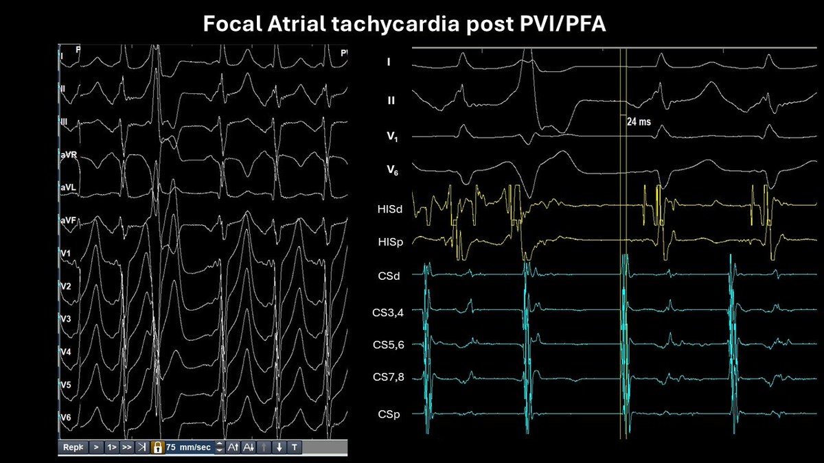 peterkistler MBBS PhD FHRS (@peterkistler3) on Twitter photo CS body ATc: unusual site! PWave notched pos in V1 and neg INF leads & lead 1 Badhwar N et al JACC 2005 Nov 15;46(10):1921-30. <a href="/BadhwarNitish/">Nitish Badhwar</a> CS body ATc: unusual site! PWave notched pos in V1 and neg INF leads & lead 1 Badhwar N et al JACC 2005 Nov 15;46(10):1921-30. <a href="/BadhwarNitish/">Nitish Badhwar</a>