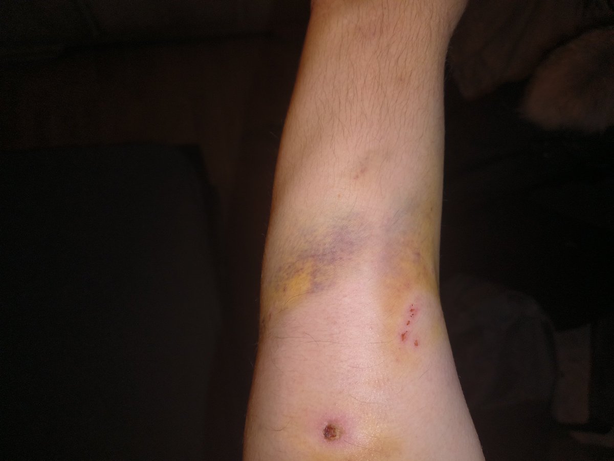 Little update about my arms from my dog attacking me 
So far I didn't have to go to the doctor and didn't take any pain meds which is a good thing. It's currently healing well. Just quite numb in the left arm but that'll go away soon.
