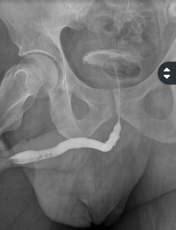 36 años estrechez uretral, una semana previa a la cirugía hizo RAO, se colocó talla y se realizó Plastia de uretra con BMG. Uretrograma de control con buenos resultados.