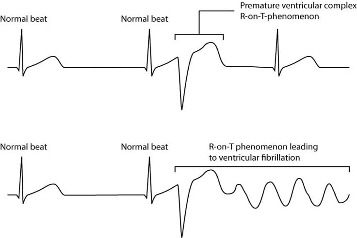 TrackYourHeart's tweet photo. R-on-T Phenomenon: A Silent Killer in Arrhythmias! 

Definition: When a premature ventricular contraction (PVC) or pacing impulse falls on the T wave, a vulnerable repolarization phase, increasing the risk of lethal arrhythmias.

Mechanism: During the relative refractory period, some myocardial cells can depolarize while others remain refractory. If an ectopic beat or external stimulus lands on the T wave, it can trigger ventricular tachycardia (VT), ventricular fibrillation (VF), or Torsades de Pointes.

⚠️ Common Causes:
✔️ PVCs (due to ischemia, electrolyte imbalances, cardiomyopathy)
✔️ Inappropriate pacing or defibrillation during the T wave
✔️ QT prolongation syndromes (congenital or drug-induced)

🚨 Consequences:
🔴 High risk of sudden cardiac arrest due to VT/VF
🔴 Can initiate Torsades de Pointes, especially in prolonged QT cases

✅ Prevention & Management:

- Avoid pacing/defib during the T wave
- Correct electrolyte imbalances (K+, Mg2+)
- Monitor QT interval in high-risk patients
- ICD implantation in those with recurrent VT/VF

The R-on-T phenomenon is a deadly but preventable event. Early recognition and intervention can save lives! 🫀
Source: American Heart Association Journals (AHA)

#Cardiology #Arrhythmia #MedX #SuddenCardiacArrest