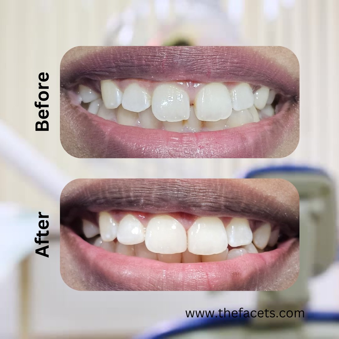 Hand crafted composite filling/ bonding - Perfect solution for closing your teeth gaps. 

Lets starts your journey towards a dream smile!  

Claim your consultation now!  

Call/ Whatsapp: +91 90 20 160 160 
Website: thefacets.com facetsdental.in
