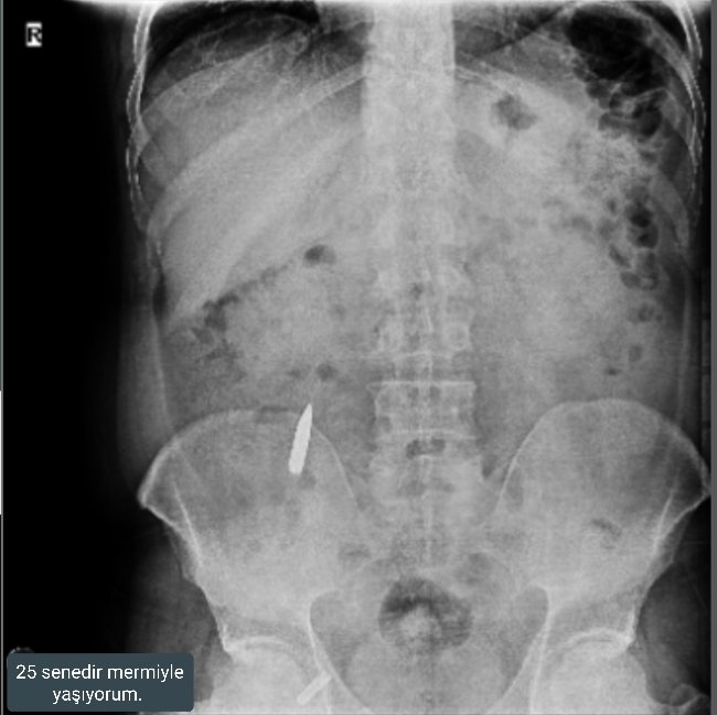 <a href="/ErtugrlGaziTmsy/">ERTUĞRUL GAZİ DEMİR</a> <a href="/TmsyGaziler/">T.M.S.Y GAZİ SAYILMAYANLAR</a> <a href="/hulusiakarmedya/">Hulusi AKAR</a> <a href="/celebimehmeta/">Mehmet Ali Çelebi</a> <a href="/RTErdogan/">Recep Tayyip Erdoğan</a> <a href="/_cevdetyilmaz/">Cevdet Yılmaz</a> <a href="/dbdevletbahceli/">Devlet Bahçeli</a> Sayın vekilim <a href="/hulusiakarmedya/">Hulusi AKAR</a>
👇👇
KURŞUN YEDİK
ŞARAPNEL YEDİK
NİYE GAZİ DEĞİLİZ
👇
#GazilikHakkımızıİstiyoruz
☝️
<a href="/RTErdogan/">Recep Tayyip Erdoğan</a>
<a href="/_cevdetyilmaz/">Cevdet Yılmaz</a>
<a href="/MahinurOzdemir/">Mahinur Özdemir Göktaş</a>
<a href="/drbetulsayan/">Dr.Betül Sayan Kaya 🇹🇷</a>  
<a href="/celebimehmeta/">Mehmet Ali Çelebi</a>
<a href="/FeyziBerdibek1/">Feyzi Berdibek🇹🇷</a>
<a href="/AhmetAYDIN_02/">Ahmet AYDIN</a>
<a href="/SayimMadak/">Dr. Sevim Sayım Madak 🇹🇷</a>
<a href="/leventalyyildiz/">Levent Ali YILDIZ</a> <a href="/mhrmkurt/">Muharrem KURT</a>