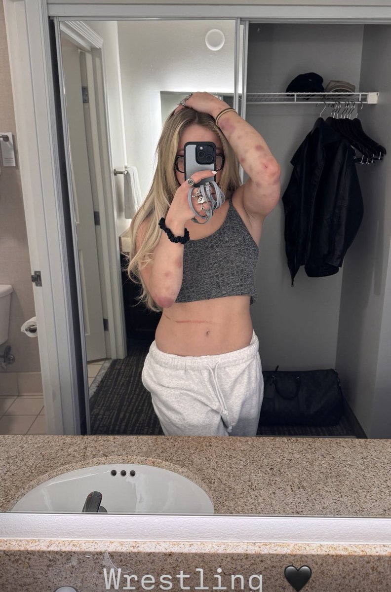 Así como quedó la Liv es como quiero que me dejen a mordiscos 😔