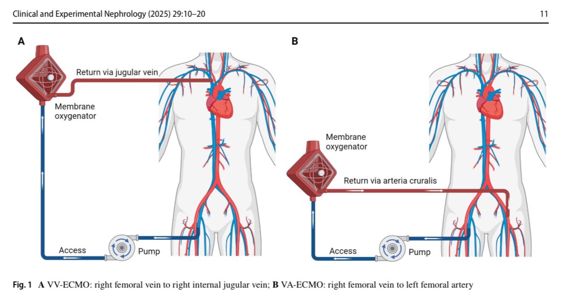 🚨ECMO &amp; AKI: A Deadly Combo🚨

Non-pulsatile flow &amp; venous congestion—ECMO risks renal hypoperfusion, leading to AKI🫀🫘

Can we prevent it? Dive into this review👇

📖AKI in ECMO: Research Progress
🔗doi.org/10.1007/s10157…

#Nephrology #ECMO #AKI #Cardiology #MedTwitter #NephX