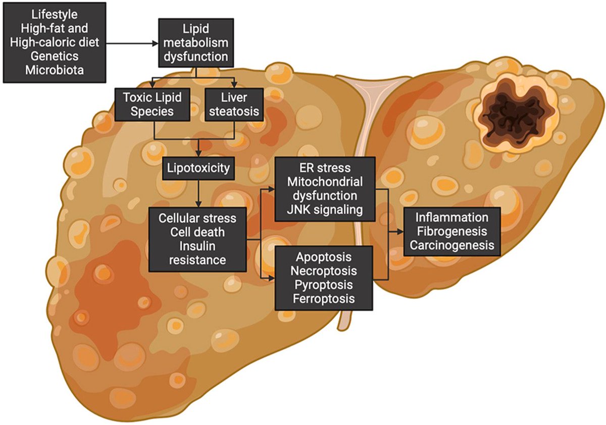 Alberto Cordero (@acorderofort) on Twitter photo Lipotoxicity-driven metabolic dysfunction-associated steatotic liver disease (MASLD)
<a href="/MAROSFO/">Rosa Fernandez</a> <a href="/ArmandoOterino/">Armando Oterino Manzanas</a> <a href="/MiriamMartinTo1/">Míriam Martín Toro</a> <a href="/lipidmir/">LipidMIR</a> <a href="/SantosGallegoMD/">Carlos G Santos-Gallego, MD</a>
atherosclerosis-journal.com/article/S0021-… Lipotoxicity-driven metabolic dysfunction-associated steatotic liver disease (MASLD)
<a href="/MAROSFO/">Rosa Fernandez</a> <a href="/ArmandoOterino/">Armando Oterino Manzanas</a> <a href="/MiriamMartinTo1/">Míriam Martín Toro</a> <a href="/lipidmir/">LipidMIR</a> <a href="/SantosGallegoMD/">Carlos G Santos-Gallego, MD</a>
atherosclerosis-journal.com/article/S0021-…