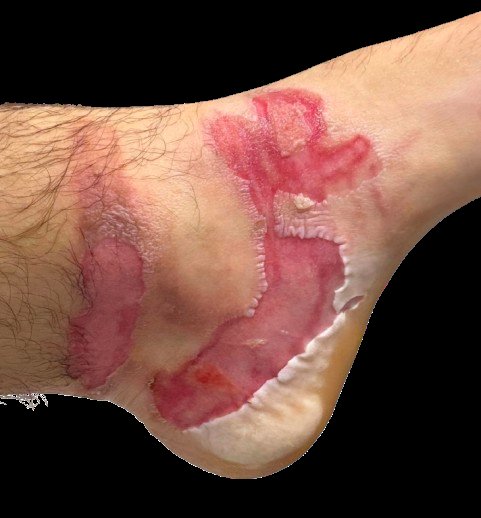 Quemadura de segundo grado en paciente joven.
Se pautan curas diarias con silvederma + linitul + gasas + crepé