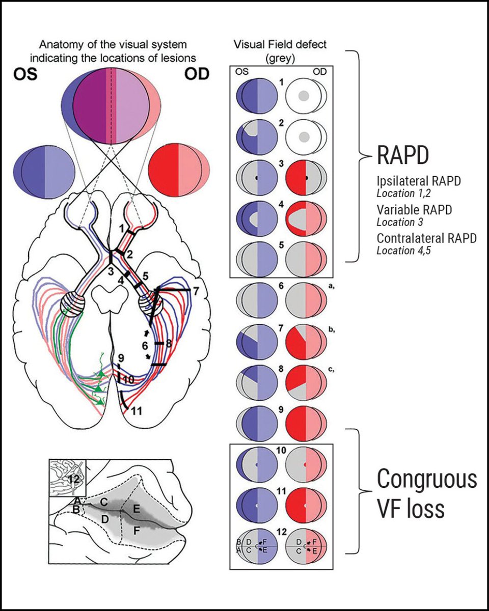 Read "Visual Field Loss and Lesions Along the Visual Pathway" in our February issue to learn how VF testing and multimodal imaging can help determine the best path forward with certain ocular diseases: reviewofoptometry.com/article/visual… 📖
#optometry #optometrist #vision #visualfield
