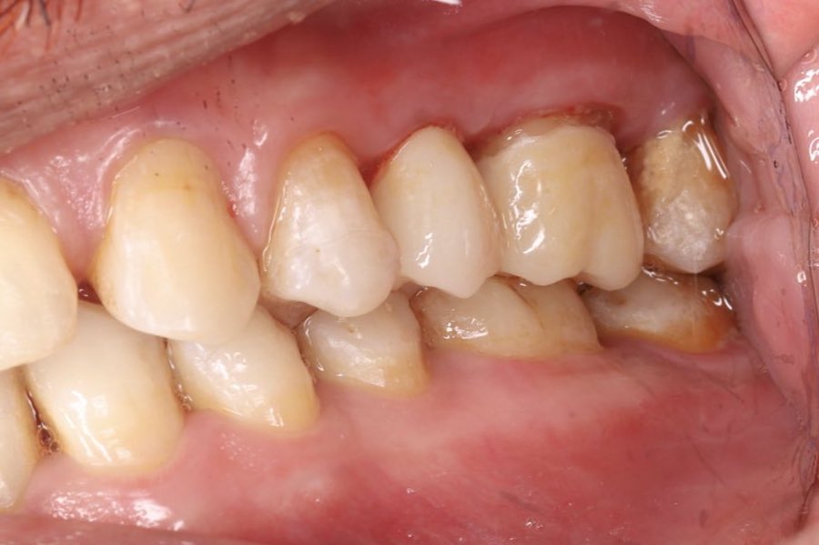 Zirconia Crowns for #25-#26