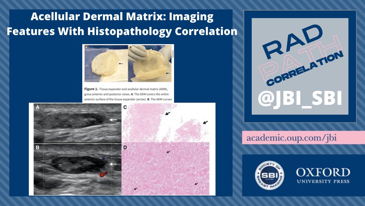 Journal of Breast Imaging (@jbi_sbi) on Twitter photo 📣NEW RAD-PATH CORRELATION 📣
✨ ADM: in postmast implant- reconstr
✨ Decellularized cadaveric dermal tissue; used as structural scaffold of extracellular matrix to reinforce the soft tissues & control positioning of an <a href="/BreastImaging/">Society of Breast Imaging</a> implant
📩 doi.org/10.1093/jbi/wb… 📣NEW RAD-PATH CORRELATION 📣
✨ ADM: in postmast implant- reconstr
✨ Decellularized cadaveric dermal tissue; used as structural scaffold of extracellular matrix to reinforce the soft tissues & control positioning of an <a href="/BreastImaging/">Society of Breast Imaging</a> implant
📩 doi.org/10.1093/jbi/wb…