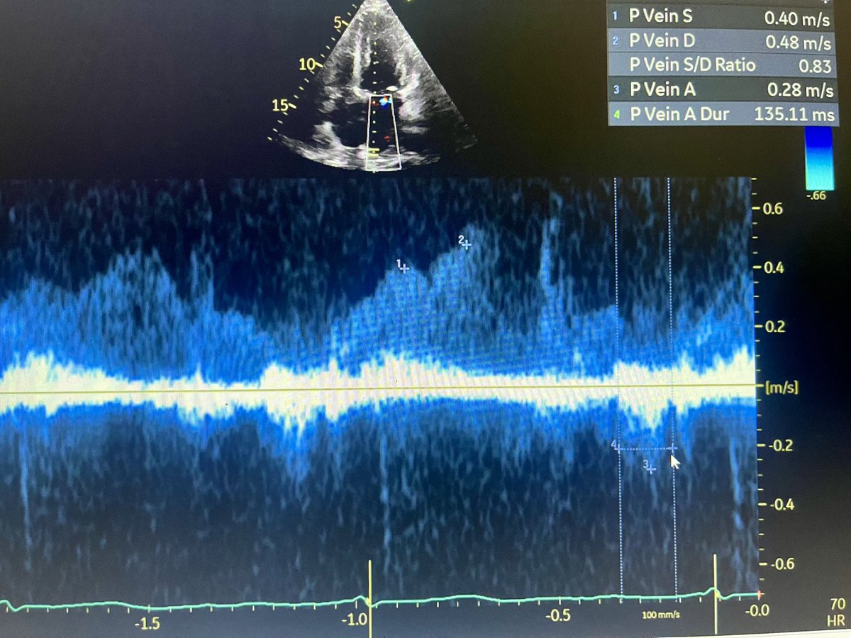 Echo for fellows (@bhaskararora_md) on Twitter photo What's wrong with this measurement?
PWD tracing of pulmonary vein flow.
<a href="/ASE360/">American Society of Echocardiography</a> <a href="/OHSUCardFellows/">OHSU Cardiology Fellowship</a> <a href="/CASivaram1/">Chittur Sivaram</a> <a href="/iamritu/">Ritu Thamman MD</a> What's wrong with this measurement?
PWD tracing of pulmonary vein flow.
<a href="/ASE360/">American Society of Echocardiography</a> <a href="/OHSUCardFellows/">OHSU Cardiology Fellowship</a> <a href="/CASivaram1/">Chittur Sivaram</a> <a href="/iamritu/">Ritu Thamman MD</a>