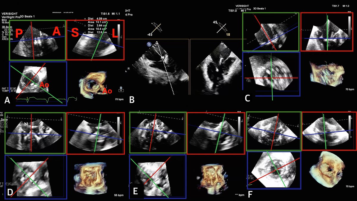 Dr. Gilbert Tang (@gilberttangmd) on Twitter photo Proud of our <a href="/LucySafi/">Lucy</a> <a href="/KHERA_MD/">Sahil Khera</a> & <a href="/MountSinaiHeart/">Mount Sinai Fuster Heart Hospital</a> <a href="/MountSinaiNYC/">Mount Sinai Health System</a> <a href="/IcahnMountSinai/">Icahn School of Medicine at Mount Sinai</a> structural heart team for this <a href="/JACCJournals/">JACC Journals</a> #JACCIMG iPix paper on #Evoque #TTVR in challenging scenarios. Practical imaging and device steering / deployment tips in pts with CIED leads, prior Proud of our <a href="/LucySafi/">Lucy</a> <a href="/KHERA_MD/">Sahil Khera</a> & <a href="/MountSinaiHeart/">Mount Sinai Fuster Heart Hospital</a> <a href="/MountSinaiNYC/">Mount Sinai Health System</a> <a href="/IcahnMountSinai/">Icahn School of Medicine at Mount Sinai</a> structural heart team for this <a href="/JACCJournals/">JACC Journals</a> #JACCIMG iPix paper on #Evoque #TTVR in challenging scenarios. Practical imaging and device steering / deployment tips in pts with CIED leads, prior