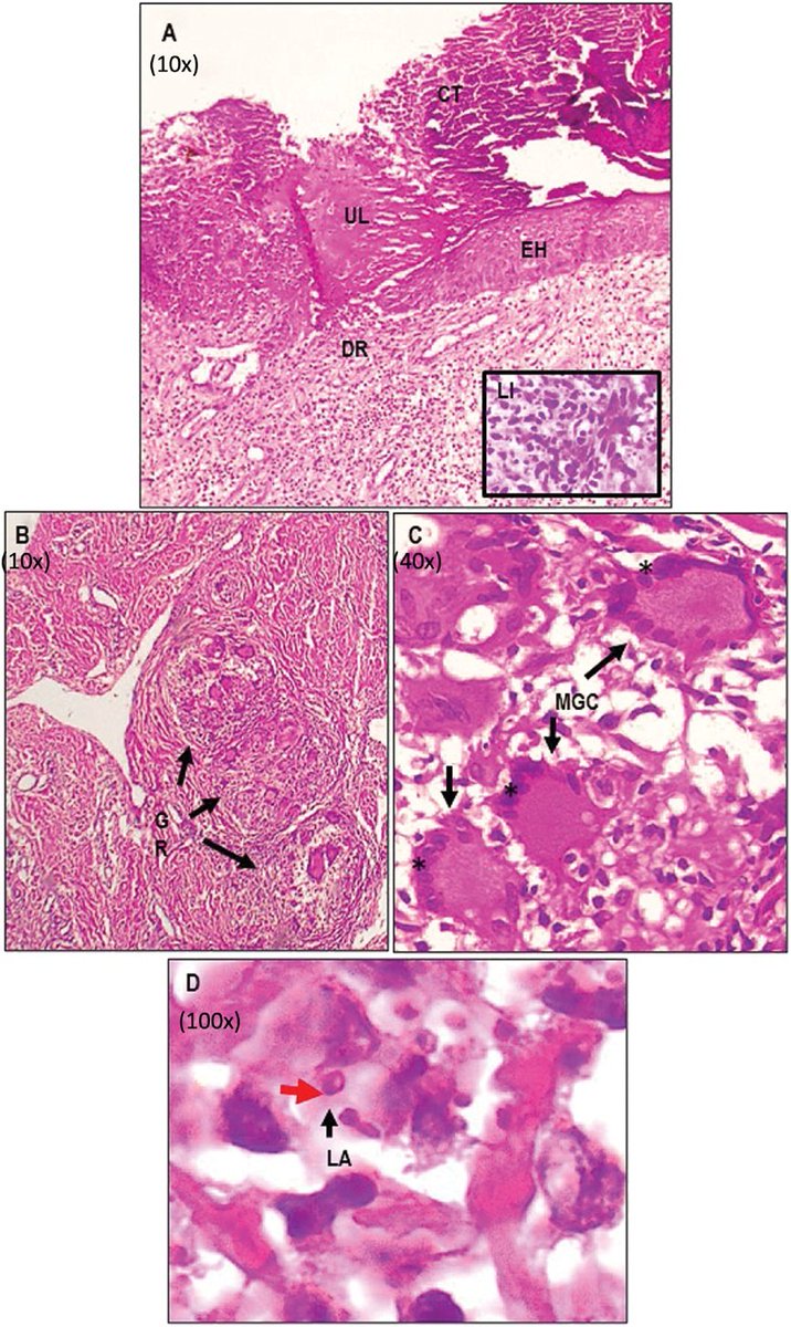 AJDP_Journal's tweet photo. #WhatsNewInDermpath
Evaluating CD1a immunohistochemistry for tegumentary leishmaniasis diagnosis in the new world: a focus on Colombia
https://t.co/dfGVJB8WcI https://t.co/60soZJjIEM