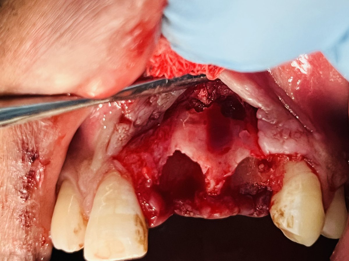 dipakraval69's tweet photo. Periapical lesion in 21,22 …. Extracted than remove lesion nd apply bone graft nd membrane….pt age only 35 year old…. https://t.co/BgOtbGtU35