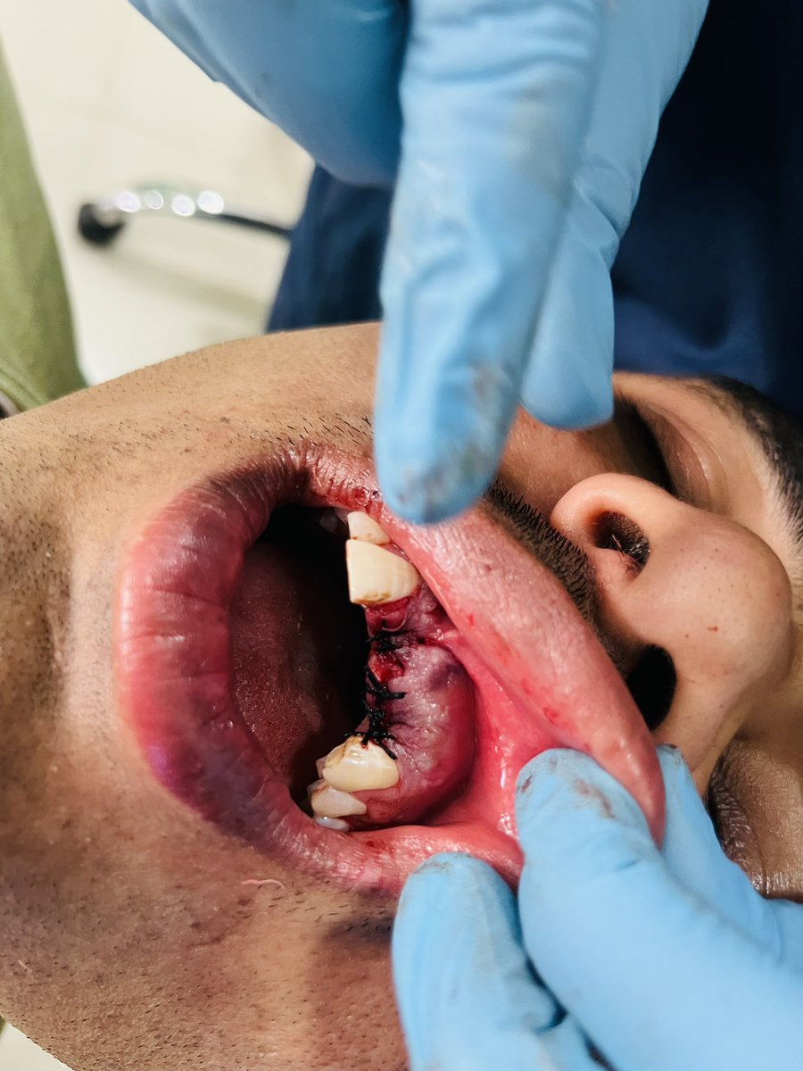 dipakraval69's tweet photo. Periapical lesion in 21,22 …. Extracted than remove lesion nd apply bone graft nd membrane….pt age only 35 year old…. https://t.co/BgOtbGtU35