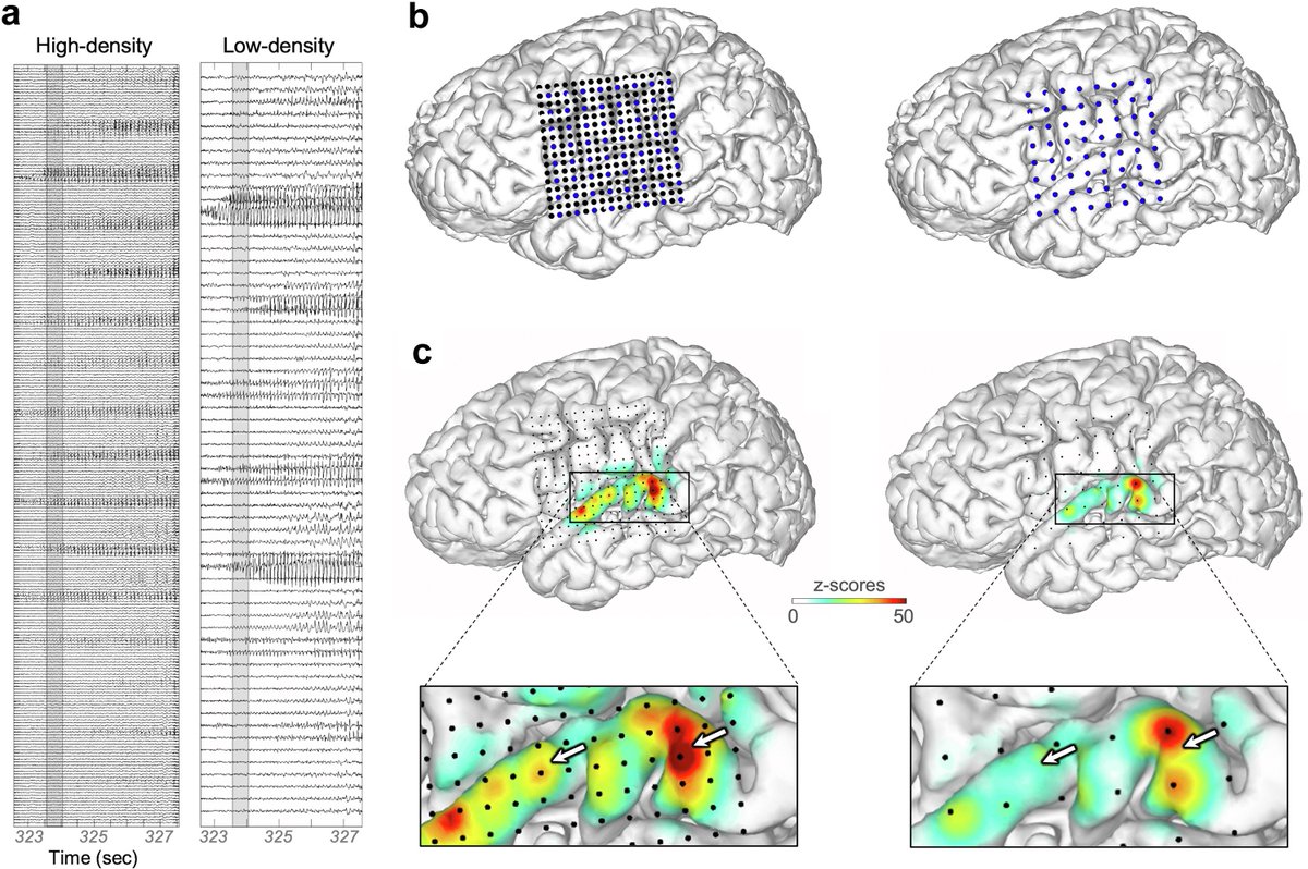 UCSFepilepsy (@ucsfepilepsy) on Twitter photo Are HIGHER densities of intracranial contacts on depths/strips/grids BETTER for finding the seizure-onset zone and its margins?
A carefully controlled study by the Kleen Lab <a href="/UCSF/">UC San Francisco</a> is published today in <a href="/TheLancet/">The Lancet</a>'s open access journal <a href="/eBioMedicine/">eBioMedicine ā The Lancet Discovery Science</a>!
thelancet.com/journals/ebiom⦠Are HIGHER densities of intracranial contacts on depths/strips/grids BETTER for finding the seizure-onset zone and its margins?
A carefully controlled study by the Kleen Lab <a href="/UCSF/">UC San Francisco</a> is published today in <a href="/TheLancet/">The Lancet</a>'s open access journal <a href="/eBioMedicine/">eBioMedicine ā The Lancet Discovery Science</a>!
thelancet.com/journals/ebiomā¦