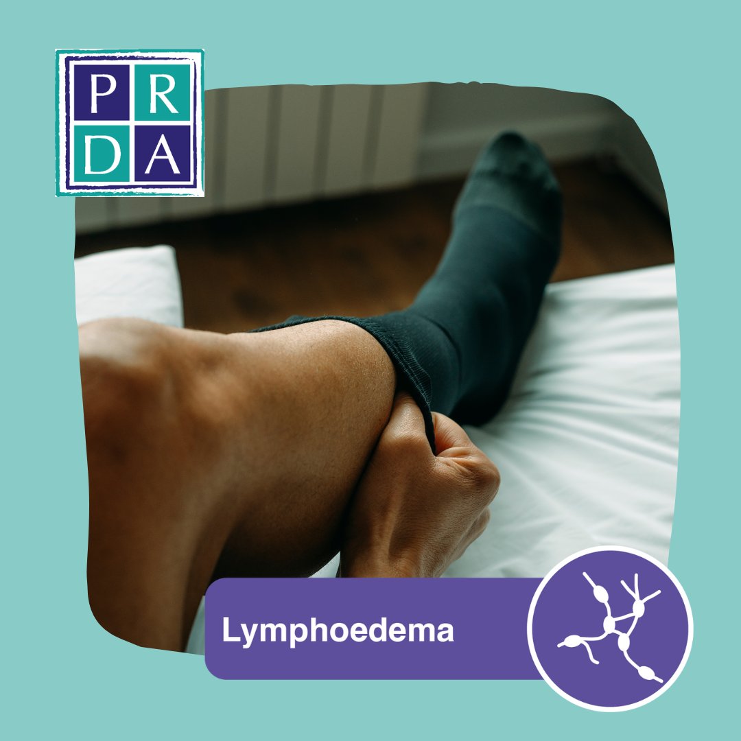 PRDA_uk's tweet photo. This #LymphoedemaAwareness week, we’re highlighting the impact of lymphoedema after pelvic radiotherapy and why early recognition and management are so important.

Learn more: https://t.co/2XUfRNptHH

#PelvicRadiationDisease #Lymphoedema #RTLateEffects #Radiotherapy https://t.co/TagGs5gKE8