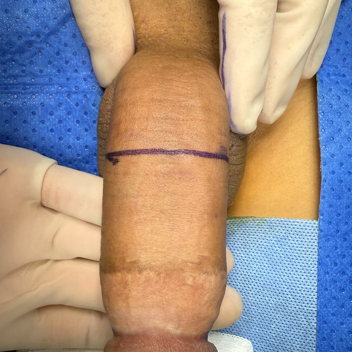 PlasticUGEMIA's tweet photo. 小切口非阴茎脱套白膜折叠手术，纠正阴茎下弯。Small incision non-penile degloving  tunica albuginea folding surgery to correct penile ventral curvature https://t.co/4SKDQ3v0Kp