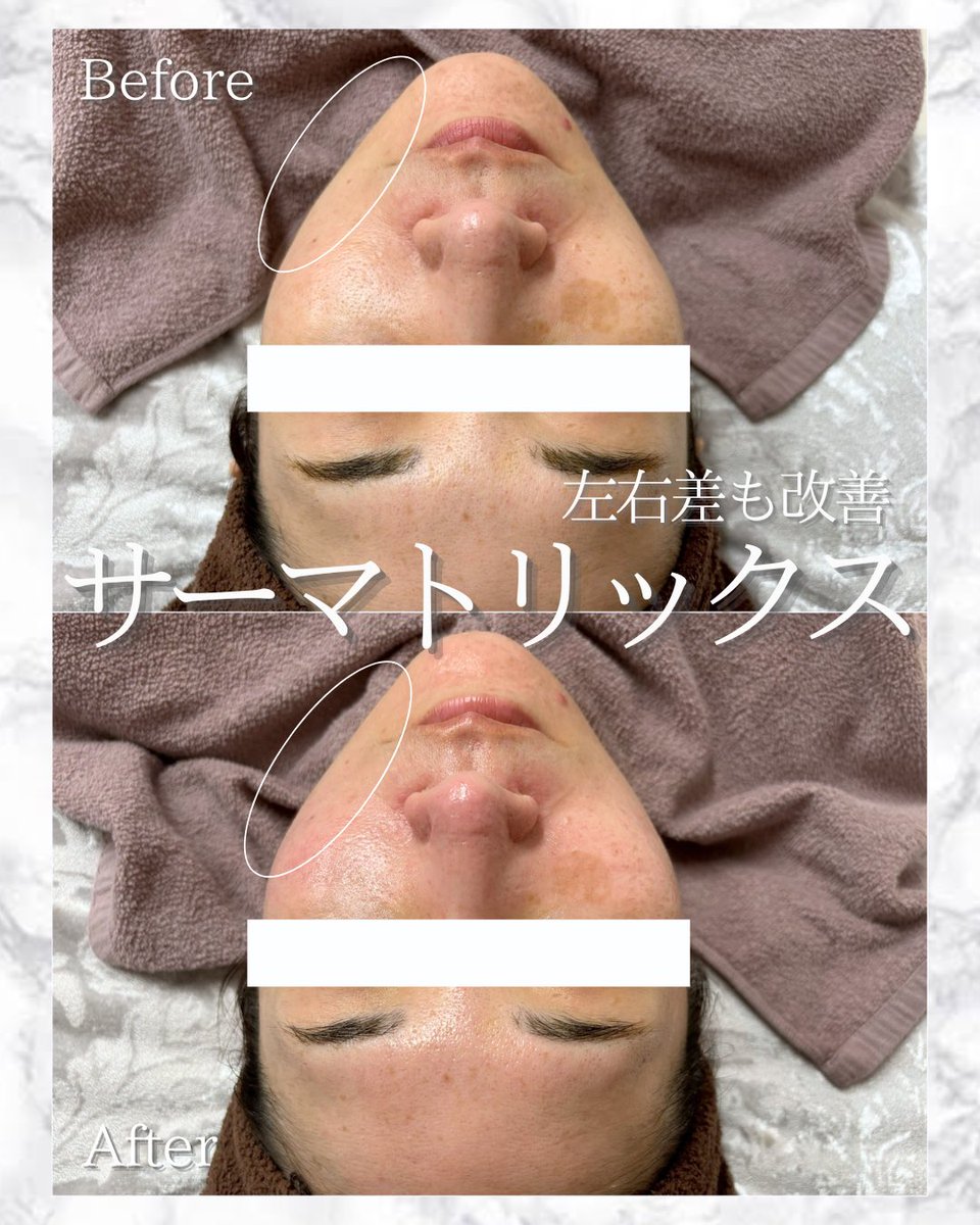 mulea_salon's tweet photo. またお顔の左右差、気になる顎下、脂肪吸引の術後ケアに◎
サーマトリックスおすすめです^ ^ https://t.co/9xaYkKfBAQ