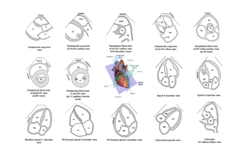 Guidelines for the Echocardiographic Assessment of the Right Heart in Adults and Special Considerations in Pulmonary Hypertension: Recommendations from the American Society of Echocardiography
onlinejase.com/article/S0894-…