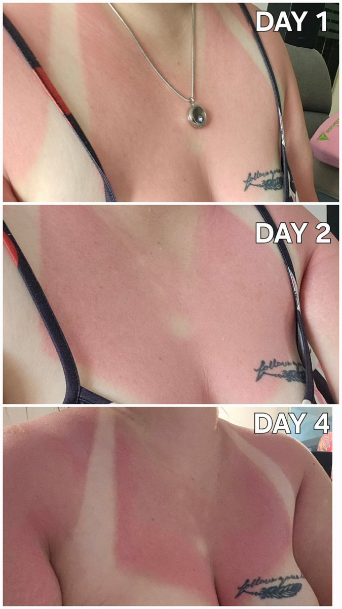 nutowlsg's tweet photo. Why is my sunburn getting redder? 😫 https://t.co/tv8h1gcLaC