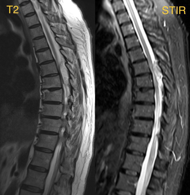 Daniel Gewolb, MD (@daniel_gewolb) on Twitter photo What is the most likely diagnosis in this 50 y/o F w/ no PMH presenting w/ progressive bilateral LE weakness?
#Medicine #Meded #Neurosurgery #Neurology #radres #futureradres #ENT #FOAMed #MRI <a href="/The_ASSR/">American Society of Spine Radiology (ASSR)</a> What is the most likely diagnosis in this 50 y/o F w/ no PMH presenting w/ progressive bilateral LE weakness?
#Medicine #Meded #Neurosurgery #Neurology #radres #futureradres #ENT #FOAMed #MRI <a href="/The_ASSR/">American Society of Spine Radiology (ASSR)</a>
