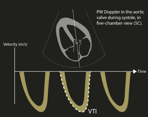 Ross Prager (@ross_prager) on Twitter photo Structure vs. function - a debate as old as time.
LVOT VTI is probably the MOST actionable measurement to guide resuscitation as it gives an accurate and repeatable measure of stroke volume.
Join <a href="/KiranRikhraj/">Kiran Rikhraj</a> <a href="/ArgaizR/">Eduardo R Argaiz</a> and myself March 10th, 2025 at 12pm (ET - Toronto) as we Structure vs. function - a debate as old as time.
LVOT VTI is probably the MOST actionable measurement to guide resuscitation as it gives an accurate and repeatable measure of stroke volume.
Join <a href="/KiranRikhraj/">Kiran Rikhraj</a> <a href="/ArgaizR/">Eduardo R Argaiz</a> and myself March 10th, 2025 at 12pm (ET - Toronto) as we