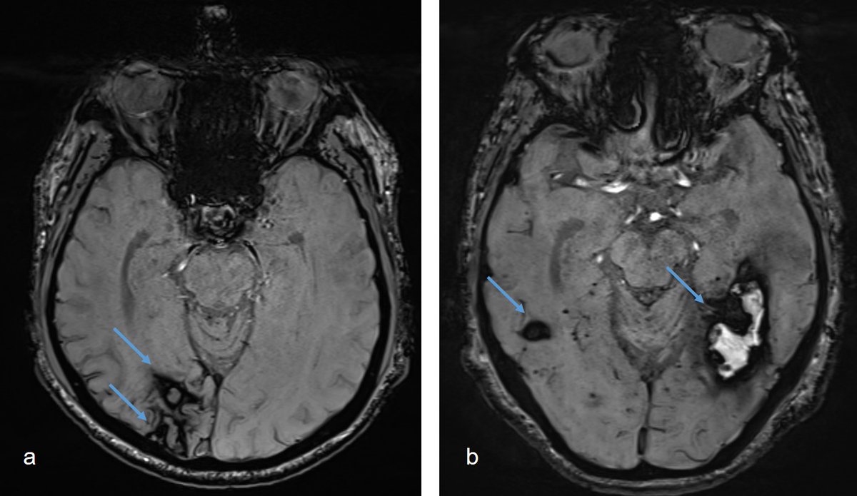 Insel Gruppe (@inselgruppe) on Twitter photo A #Study by EURECA in collaboration with #InselGruppe shows: recurrent #brain haemorrhages occur more frequently near previous bleeding sites. Over 700 patients were examined.
jamanetwork.com/journals/jamanâŠ
<a href="/unibern/">UniversitÀt Bern</a> <a href="/MedFacultyUniBE/">Faculty of Medicine, University of Bern</a>
<a href="/mbgoeldlin/">Martina Göldlin</a> @davidseiffge <a href="/StrokeBern/">Stroke Research Center Bern</a>
#Neurology A #Study by EURECA in collaboration with #InselGruppe shows: recurrent #brain haemorrhages occur more frequently near previous bleeding sites. Over 700 patients were examined.
jamanetwork.com/journals/jamanâŠ
<a href="/unibern/">UniversitÀt Bern</a> <a href="/MedFacultyUniBE/">Faculty of Medicine, University of Bern</a>
<a href="/mbgoeldlin/">Martina Göldlin</a> @davidseiffge <a href="/StrokeBern/">Stroke Research Center Bern</a>
#Neurology