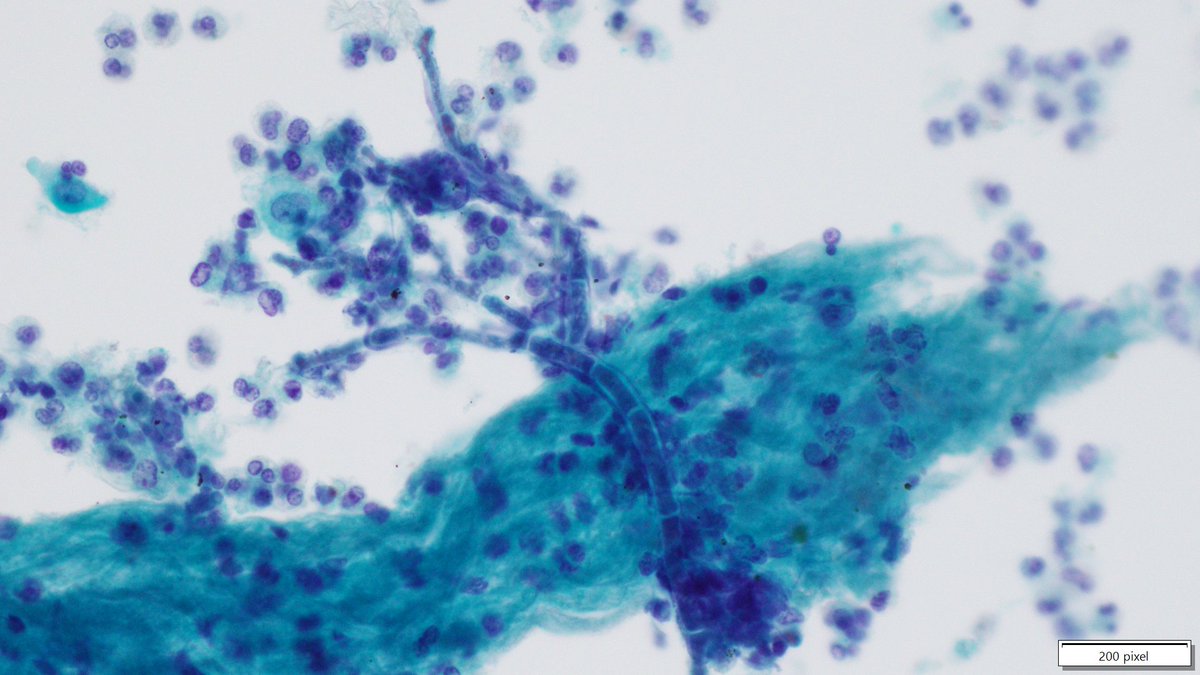 Hiding in plain sight, Aspergillus in a lung FNA sample...
#Cytopathology