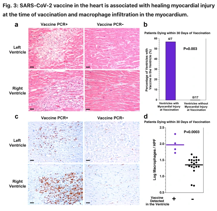 kevinnbass's tweet photo. Paper in Nature journal Vaccines shows vaccine mRNA in the heart of people who got myocarditis and died after COVID vaccination.

It also shows infiltration of immune cells into the same areas, suggesting that the mRNA is provoking an immune response in the heart. https://t.co/bn40nPyrke