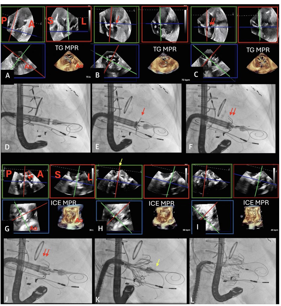 Lucy (@lucysafi) on Twitter photo Excited to share our new paper "Intraprocedural Guidance for Transcatheter Tricuspid Valve Replacement in Challenging Scenarios" published in <a href="/JACCJournals/">JACC Journals</a>
Check it out! 🔗 ➠ bit.ly/4kmiCrp
<a href="/GilbertTangMD/">Dr. Gilbert Tang</a> <a href="/KHERA_MD/">Sahil Khera</a> <a href="/DoctorKini/">DoctorKini</a> <a href="/ParasuramMD/">Parasuram Krishnamoorthy MD</a> <a href="/MountSinaiHeart/">Mount Sinai Fuster Heart Hospital</a> Excited to share our new paper "Intraprocedural Guidance for Transcatheter Tricuspid Valve Replacement in Challenging Scenarios" published in <a href="/JACCJournals/">JACC Journals</a>
Check it out! 🔗 ➠ bit.ly/4kmiCrp
<a href="/GilbertTangMD/">Dr. Gilbert Tang</a> <a href="/KHERA_MD/">Sahil Khera</a> <a href="/DoctorKini/">DoctorKini</a> <a href="/ParasuramMD/">Parasuram Krishnamoorthy MD</a> <a href="/MountSinaiHeart/">Mount Sinai Fuster Heart Hospital</a>