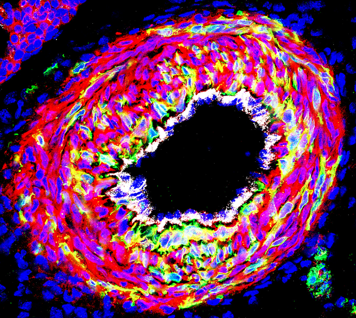 Heart Research Institute (@hriaust) on Twitter photo Under the Microscope ๐ฌโค๏ธ๐๐ฉโ๐ฌ
This remarkable image, taken by Dr Ashish Misra <a href="/AshishMisraLab/">Ashish Misra</a>, captures a cross-section of a blood vessel affected by a congenital #heartdefect, showing the narrowing that restricts blood flow from the heart to the rest of the body. Under the Microscope ๐ฌโค๏ธ๐๐ฉโ๐ฌ
This remarkable image, taken by Dr Ashish Misra <a href="/AshishMisraLab/">Ashish Misra</a>, captures a cross-section of a blood vessel affected by a congenital #heartdefect, showing the narrowing that restricts blood flow from the heart to the rest of the body.