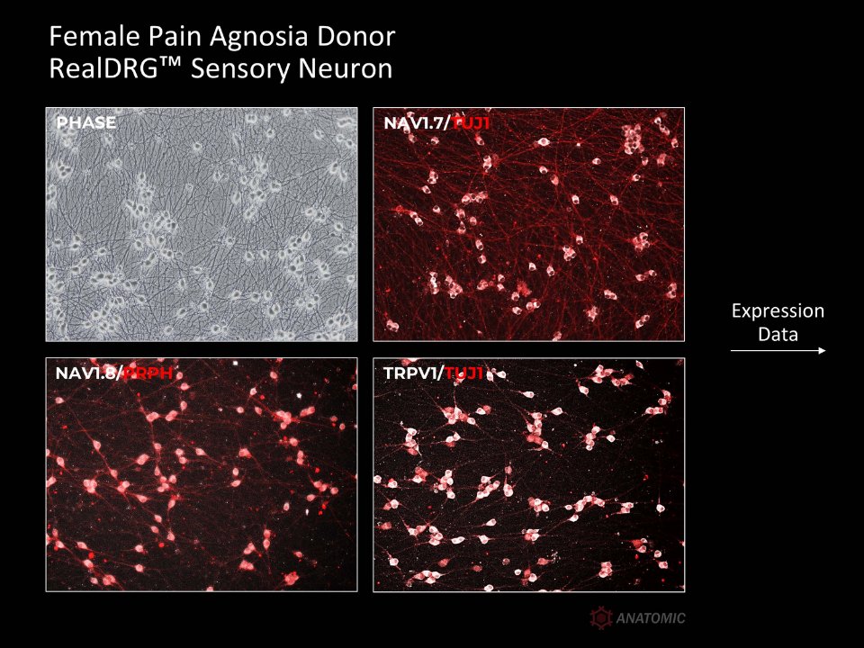 AnatomicTech's tweet image. 🧒🏻👧🏽👦🏼👩🏽‍🦱Multiple donors. Same process. Sensory neurons derived from hiPSC lines (both healthy and diseased) express key ion channel targets for pain - NaV1.7, NaV1.8, and TRPV1
#NotYourAverageNeuron #CompleteTheCircuit #DiseaseModeling #PainResearch