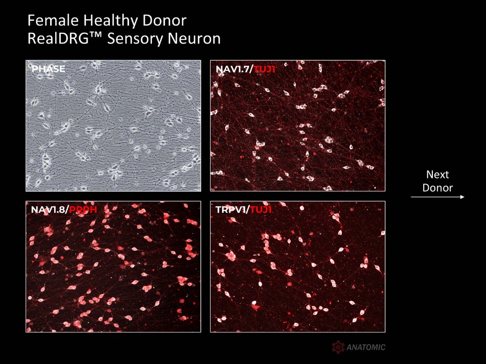 AnatomicTech's tweet image. 🧒🏻👧🏽👦🏼👩🏽‍🦱Multiple donors. Same process. Sensory neurons derived from hiPSC lines (both healthy and diseased) express key ion channel targets for pain - NaV1.7, NaV1.8, and TRPV1
#NotYourAverageNeuron #CompleteTheCircuit #DiseaseModeling #PainResearch