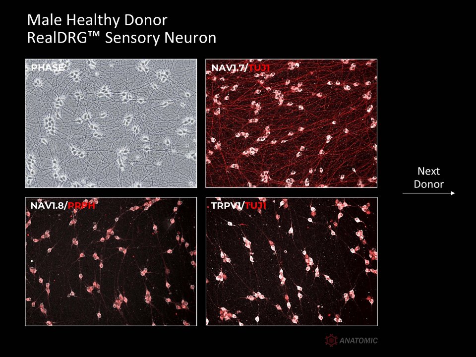 AnatomicTech's tweet image. 🧒🏻👧🏽👦🏼👩🏽‍🦱Multiple donors. Same process. Sensory neurons derived from hiPSC lines (both healthy and diseased) express key ion channel targets for pain - NaV1.7, NaV1.8, and TRPV1
#NotYourAverageNeuron #CompleteTheCircuit #DiseaseModeling #PainResearch