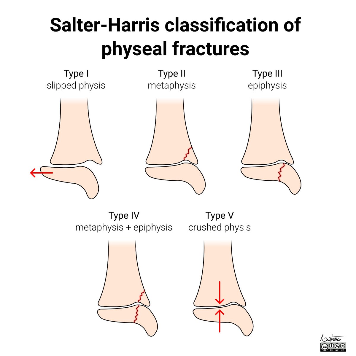 Leonardo Lustosa 🦴 (@drleolustosa) on Twitter photo I have updated my illustration of the Salter-Harris classification. Gonna use it in a few projects 🤓👍🏻 I have updated my illustration of the Salter-Harris classification. Gonna use it in a few projects 🤓👍🏻