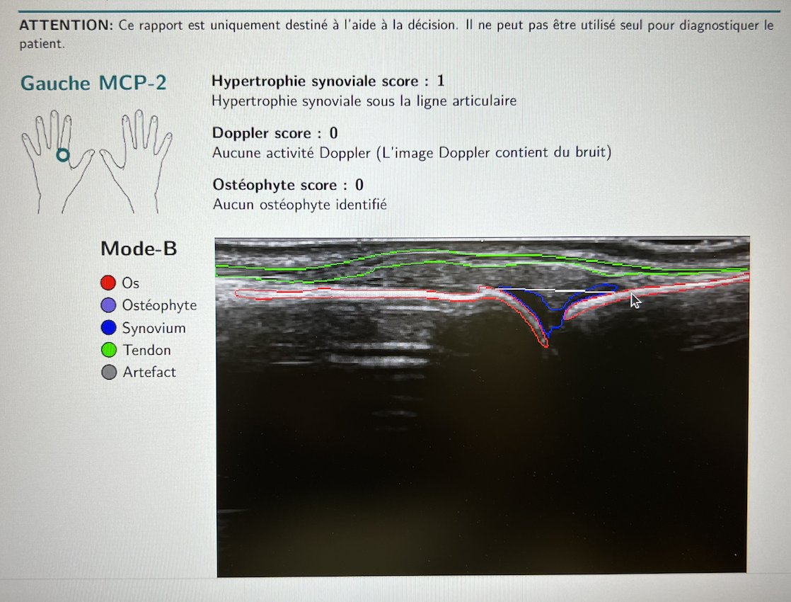 Just tried Arthur, the automatic ultrasound machine, and honestly, the results are spectacular! Sooner rather than later, it will start working with us in hospitals 😉 Thanks to #Rheumatology #CHUV