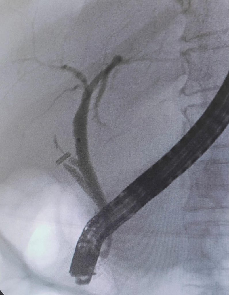 A middle-aged woman with a history of post-laparoscopic cholecystectomy, complicated by a biliary leak and bleeding at another facility, presented to our center. ERCP revealed the following findings:
. <a href="/ASGEendoscopy/">ASGE GI Endoscopy</a> <a href="/ESGE_news/">ESGE</a> <a href="/AmCollegeGastro/">ACG</a> <a href="/videogie/">VideoGIE Journal</a> <a href="/docdhir/">vinay dhir</a> <a href="/DrLakhtakia/">Sundeep Lakhtakia</a>