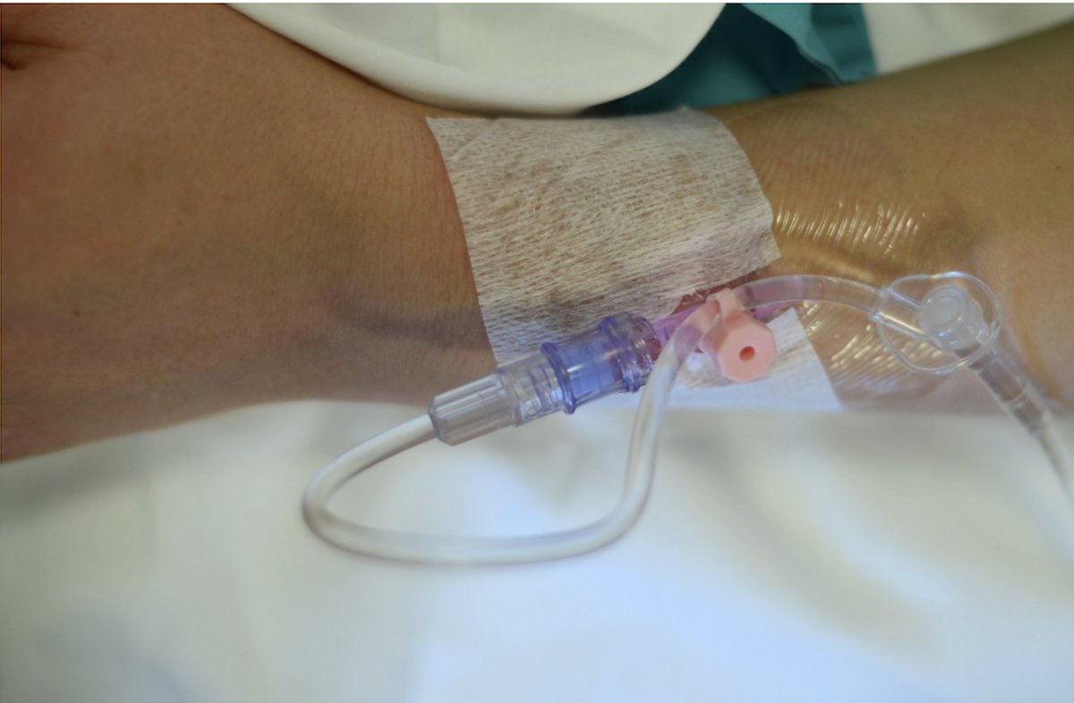 Allison Lee (@allisonleenyc) on Twitter photo What level of IV access is standard on your L&D Unit?🧐 <a href="/PennAnesthesia/">Penn Anesthesia</a> fellow Dr Scott Seki discusses his #OBAnes study on 🏥adherence to reccs for minimum access for 🤰 #CesareanDelivery <a href="/YAnesthesiology/">Yale Anesthesiology</a> podcast with <a href="/gonzalez_fiol/">ANTONIO GONZALEZ FIOL</a> : podcasts.apple.com/us/podcast/int… What level of IV access is standard on your L&D Unit?🧐 <a href="/PennAnesthesia/">Penn Anesthesia</a> fellow Dr Scott Seki discusses his #OBAnes study on 🏥adherence to reccs for minimum access for 🤰 #CesareanDelivery <a href="/YAnesthesiology/">Yale Anesthesiology</a> podcast with <a href="/gonzalez_fiol/">ANTONIO GONZALEZ FIOL</a> : podcasts.apple.com/us/podcast/int…