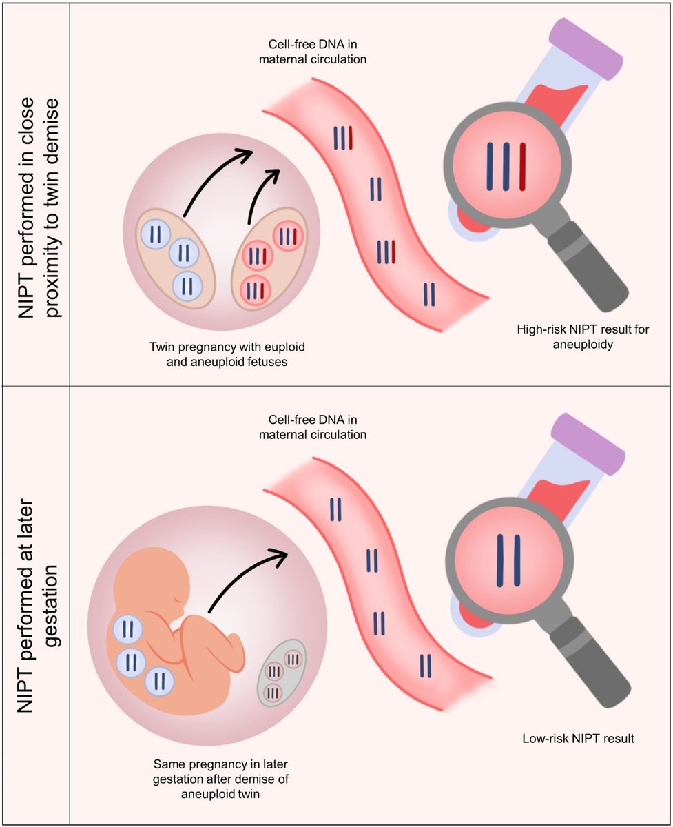 AJOG Expert Review: Placental, maternal, fetal, and technical origins of false-positive cell-free DNA screening results - Mechanism of false-positive NIPT result by demise of aneuploidy-affected twin ow.ly/k4mE50RajXU