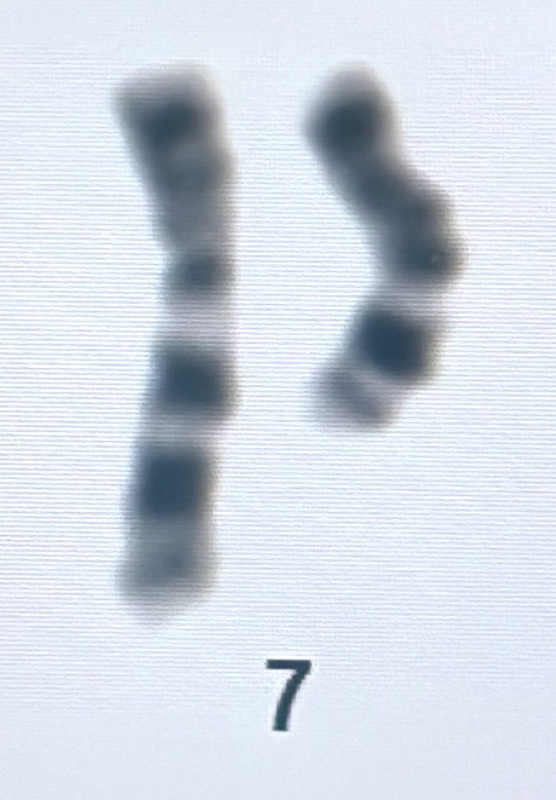 🔝Nice 7q deletion detected in PB limphocytosis