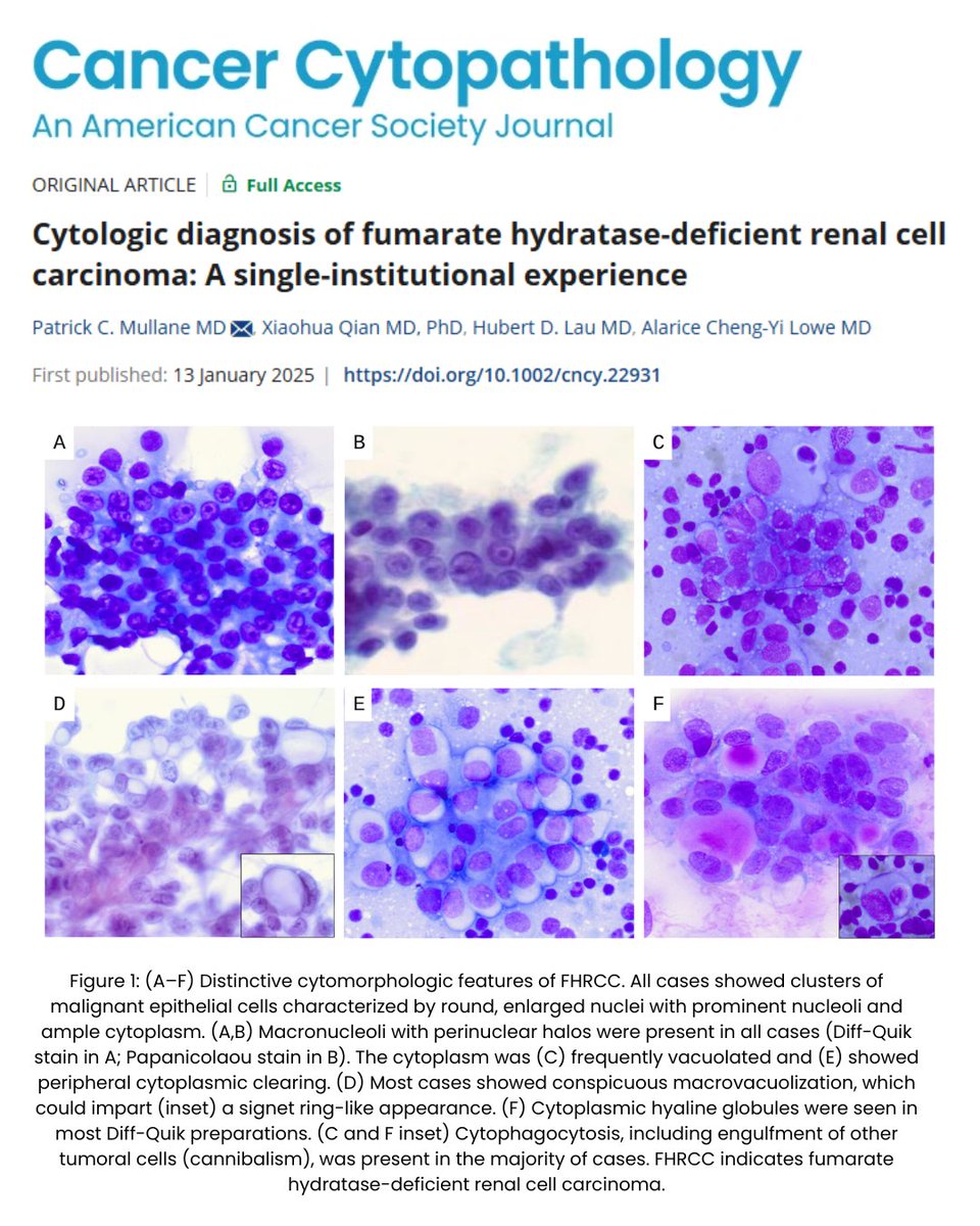 Cancer Cytopathology (@cancercytopath) on Twitter photo FHRCC cytology shows key features supporting diagnosis. Confirm with FH and 2SC IHC on limited biopsies.
acsjournals.onlinelibrary.wiley.com/doi/10.1002/cnโฆ
<a href="/Alaricelowe/">Ali Lowe</a> <a href="/pcmullane/">Patrick Mullane</a> <a href="/HubertLauMD/">Hubert Lau</a> <a href="/md_qian/">Xiaohua Qian, MD</a> <a href="/StanfordPath/">Stanford Pathology</a> #CytoPath #IHCPath FHRCC cytology shows key features supporting diagnosis. Confirm with FH and 2SC IHC on limited biopsies.
acsjournals.onlinelibrary.wiley.com/doi/10.1002/cnโฆ
<a href="/Alaricelowe/">Ali Lowe</a> <a href="/pcmullane/">Patrick Mullane</a> <a href="/HubertLauMD/">Hubert Lau</a> <a href="/md_qian/">Xiaohua Qian, MD</a> <a href="/StanfordPath/">Stanford Pathology</a> #CytoPath #IHCPath