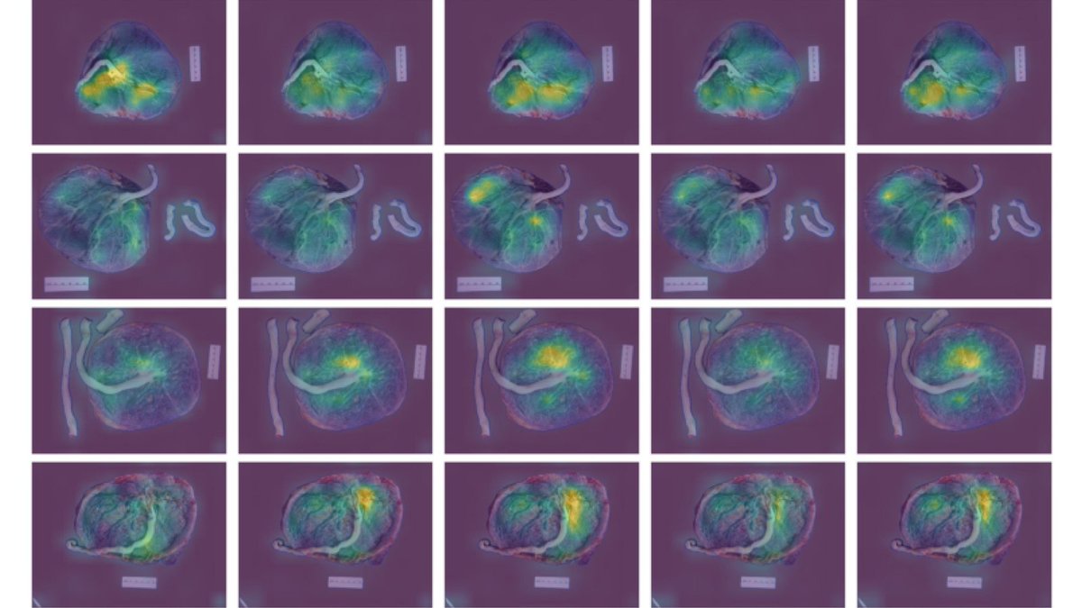 NIBIB (@nibibgov) on Twitter photo Researchers <a href="/ISTatPENNSTATE/">Penn State College of IST</a> & <a href="/pennstatehhd/">Penn State HHD</a> are developing an AI tool to evaluate placental photos that could predict adverse outcomes, like infection or sepsis. This tech could someday flag patients for enhanced monitoring or immediate care. Learn more: go.nih.gov/Ss9eXlu Researchers <a href="/ISTatPENNSTATE/">Penn State College of IST</a> & <a href="/pennstatehhd/">Penn State HHD</a> are developing an AI tool to evaluate placental photos that could predict adverse outcomes, like infection or sepsis. This tech could someday flag patients for enhanced monitoring or immediate care. Learn more: go.nih.gov/Ss9eXlu