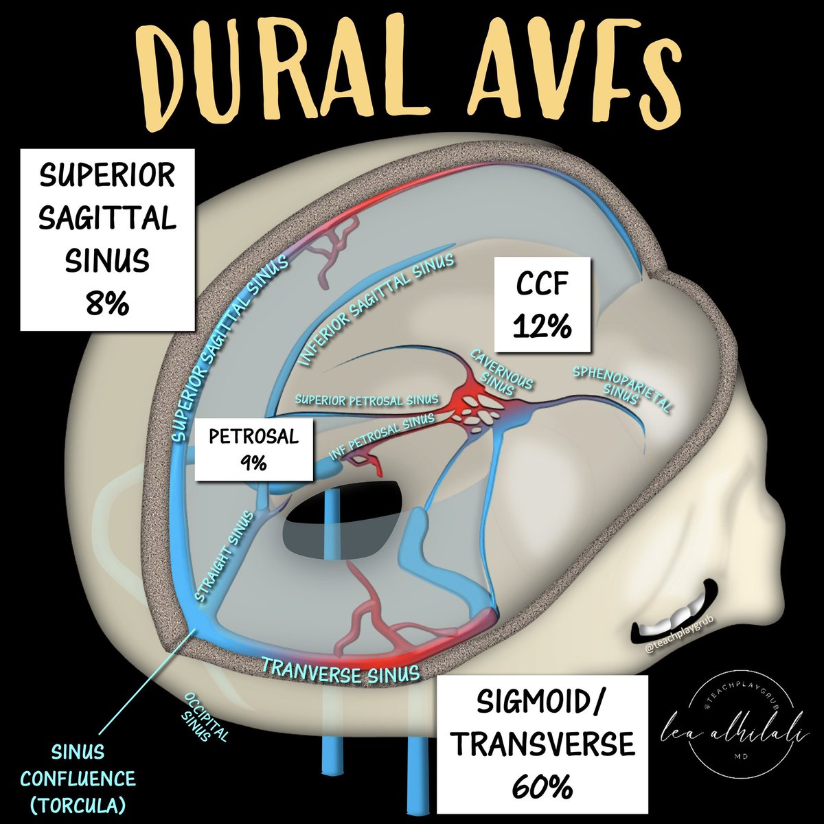 Our most limited resource is time!
 
You don’t want to waste time looking for things in a region if they are not going to be there!
 
When it comes to dural AVFs, they are overwhelming at the transverse/sigmoid sinus.
 
So if you see findings that suggest a dural AVF, look there