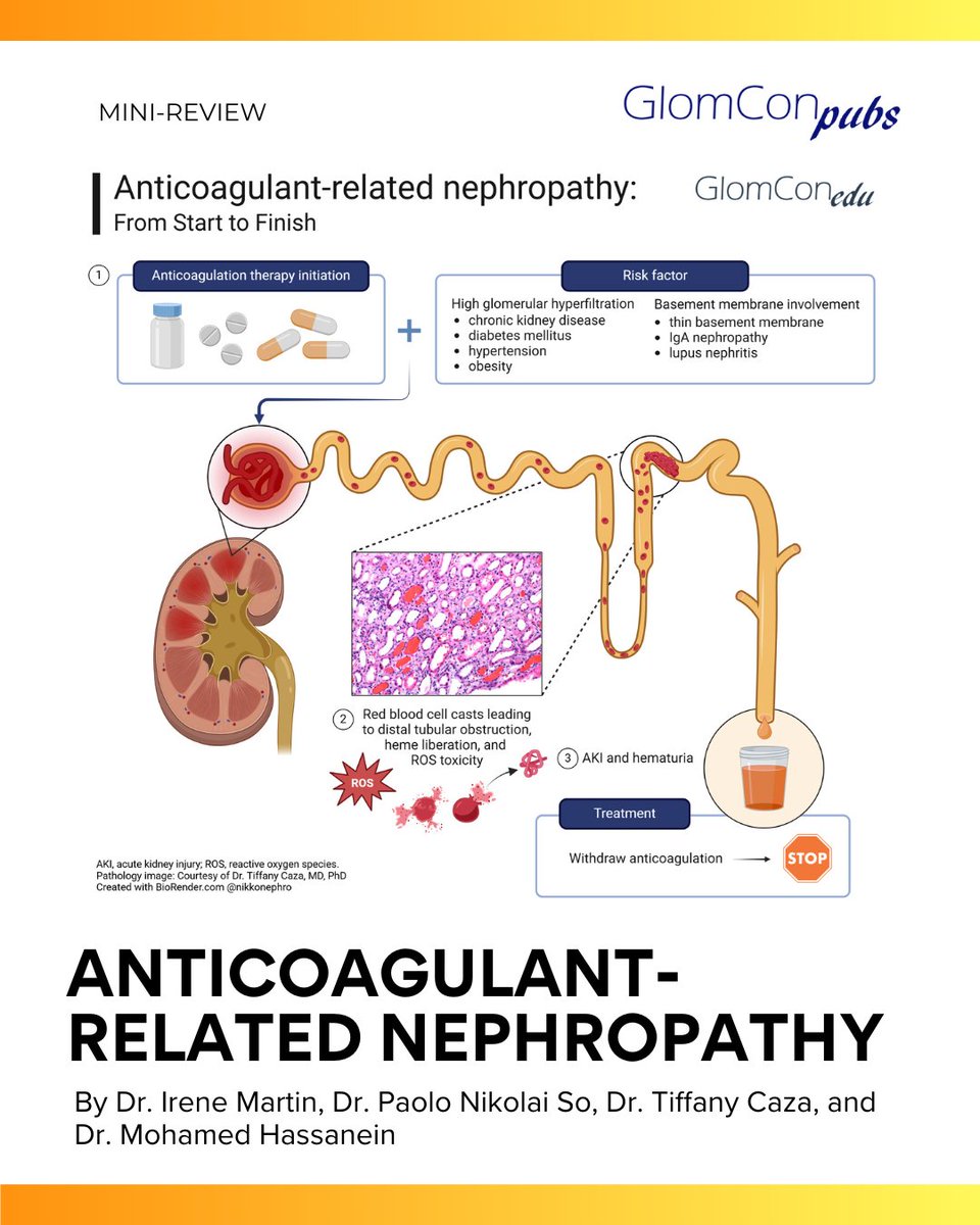 Anticoagulant-related nephropathy by Dr. Irene Martin, Dr. Paolo Nikolai So, Dr. Tiffany Caza and Dr. Mohamed Hassanein

Read here 👉 pubs.glomcon.org/anticoagulant-…

#GlomCon