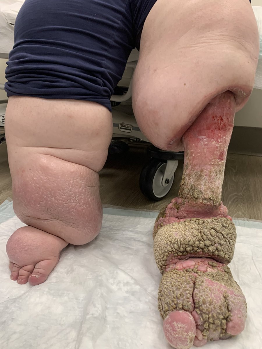 Kuldeep1926's tweet photo. Lack of compliance with compression and weight gain can often lead to worsening of #lymphedema after #debulking #surgery #vascular @FutureVascSurgn https://t.co/kzGwK5UVfH