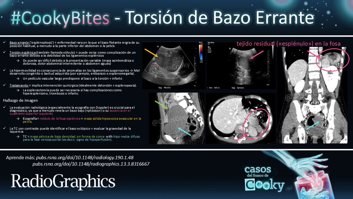 Casos de Cooky (@casoscooky) on Twitter photo Respuesta: Torsión de bazo errante
Aprende más:
pubs.rsna.org/doi/10.1148/ra…
pubs.rsna.org/doi/10.1148/ra…
#CasosCooky #CookyBites #158 #RGphx <a href="/cookyscan1/">Cooky Menias</a> <a href="/RadioGraphics/">RadioGraphics</a>
Traducción: <a href="/apaezcarpio/">Alfredo Páez-Carpio</a> Respuesta: Torsión de bazo errante
Aprende más:
pubs.rsna.org/doi/10.1148/ra…
pubs.rsna.org/doi/10.1148/ra…
#CasosCooky #CookyBites #158 #RGphx <a href="/cookyscan1/">Cooky Menias</a> <a href="/RadioGraphics/">RadioGraphics</a>
Traducción: <a href="/apaezcarpio/">Alfredo Páez-Carpio</a>