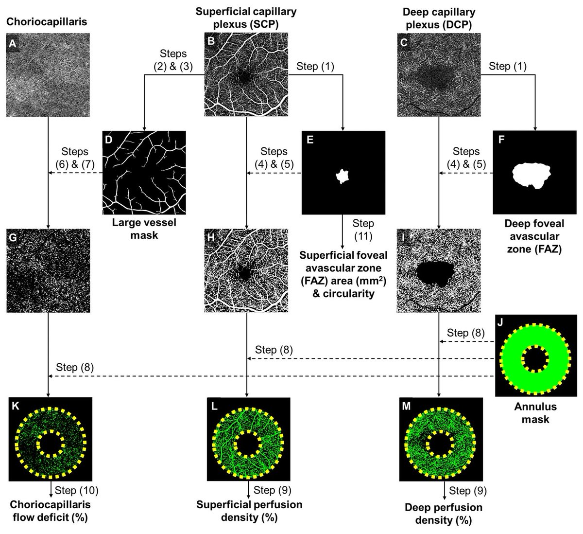 Progressive Retinal Neurodegeneration May Precede ONH Evidence in MS Patients

OCT and OCT-A can monitor disease progression and severity in those without a history of optic neuritis.
reviewofoptometry.com/article/progre…
#optometry #retina