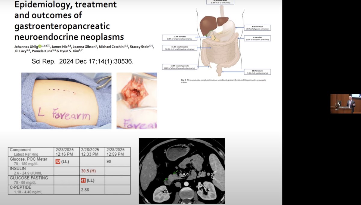 Yale Cancer Center (@yalecancer) on Twitter photo Thank you to Dr. Douglas Evans <a href="/MedicalCollege/">Medical College of Wisconsin</a> for presenting #GrandRounds + #Schnog Lecture discussing important advances in pretreatment staging, therapy, and palliative care for #pancreaticcancer. Watch his talk now youtube.com/watch?v=7oXlcS…. <a href="/SmilowCancer/">Smilow Cancer Hospital</a> <a href="/YaleMed/">Yale School of Medicine</a> <a href="/YNHH/">Yale New Haven Hosp</a> Thank you to Dr. Douglas Evans <a href="/MedicalCollege/">Medical College of Wisconsin</a> for presenting #GrandRounds + #Schnog Lecture discussing important advances in pretreatment staging, therapy, and palliative care for #pancreaticcancer. Watch his talk now youtube.com/watch?v=7oXlcS…. <a href="/SmilowCancer/">Smilow Cancer Hospital</a> <a href="/YaleMed/">Yale School of Medicine</a> <a href="/YNHH/">Yale New Haven Hosp</a>