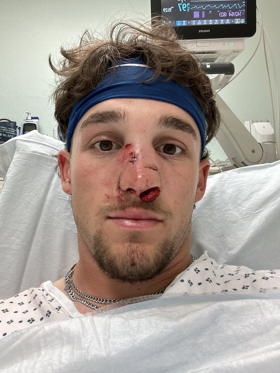 AaronStrong2023's tweet image. After taking a pitch to the face last week the doctors informed me that I would need reconstructive surgery for my nose and my season is over.
Taking this as an opportunity to further myself as a player in preparation for a massive ‘26 season